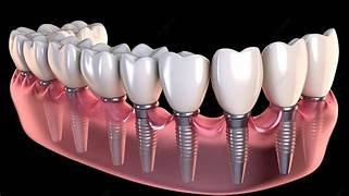 Dental Implant System